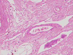 Low and hgh power views of lymphatic invasion - note adjacent artery & vein